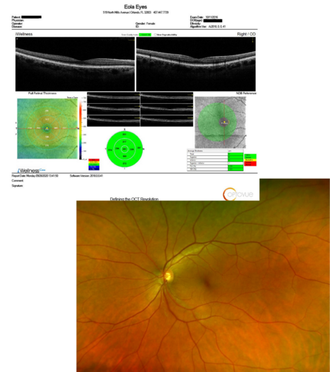 optomap